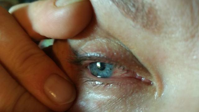 Где удалить окалину из глаза в Москве Где удалить окалину из глаза в Москве