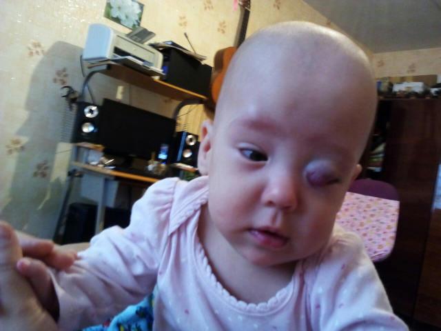 Цена операции по удалению гемангиомы на веке Стоимость удаления гемангиомы века